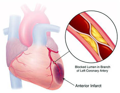 A Likely Link Between Stress And Heart Disease: Viral Reactivation